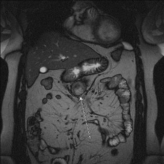 МРТ органов брюшной полости Киев